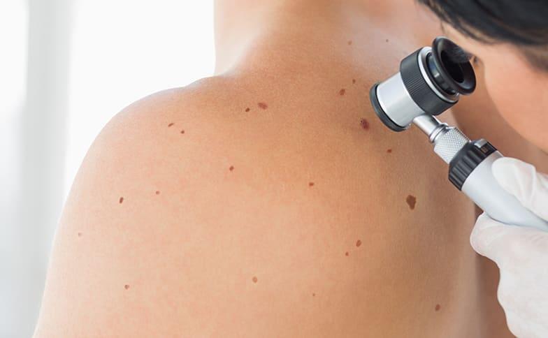 Skin Cancer Screening - Early Detection Saves Lives